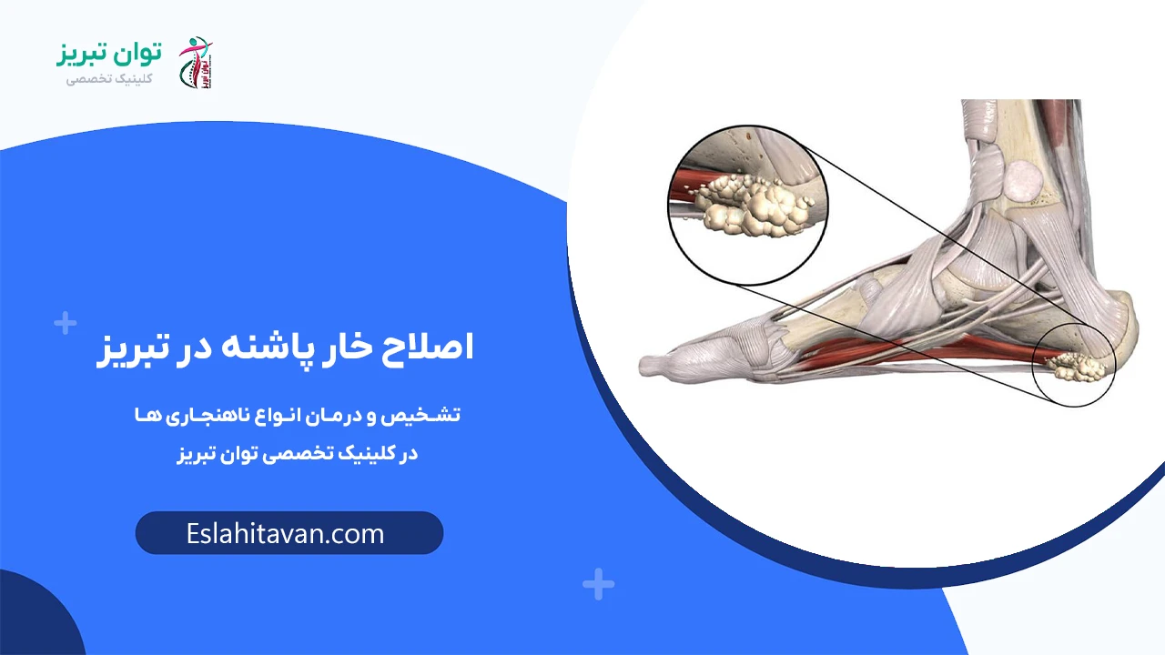 اصلاح-خار-پاشنه-در-تبریز