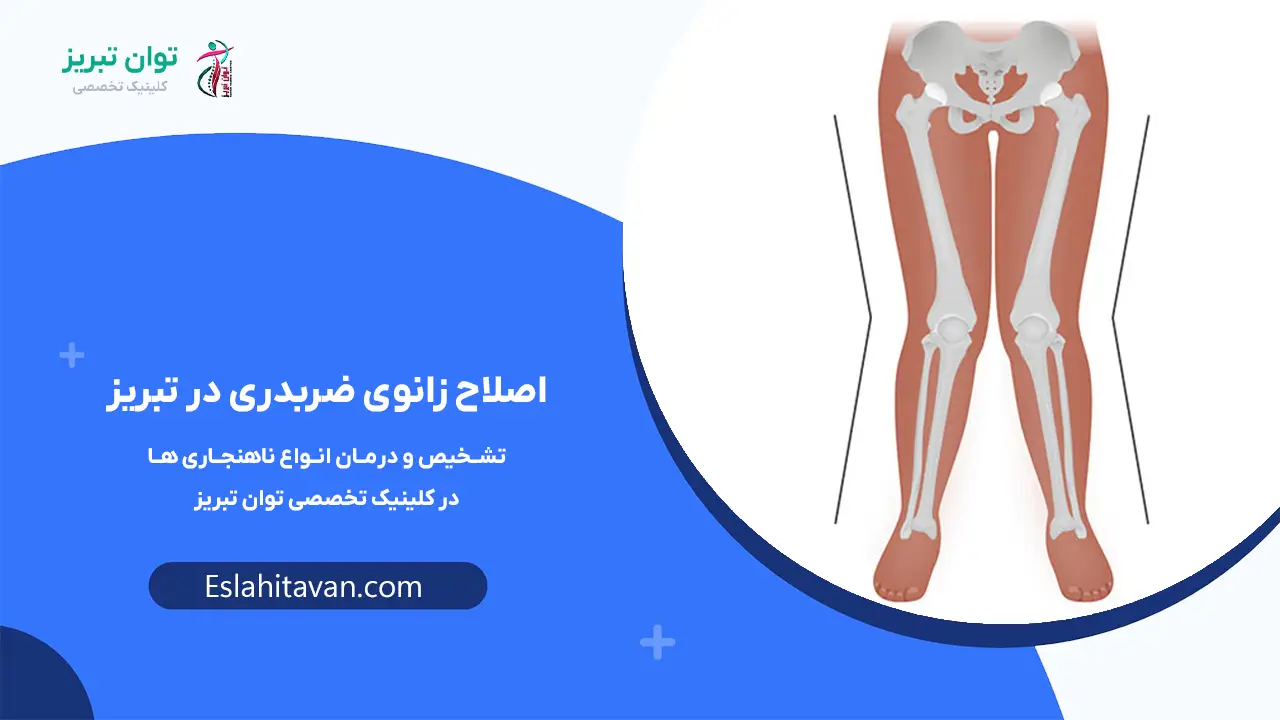 اصلاح-زانوی-ضربدری-در-تبریز