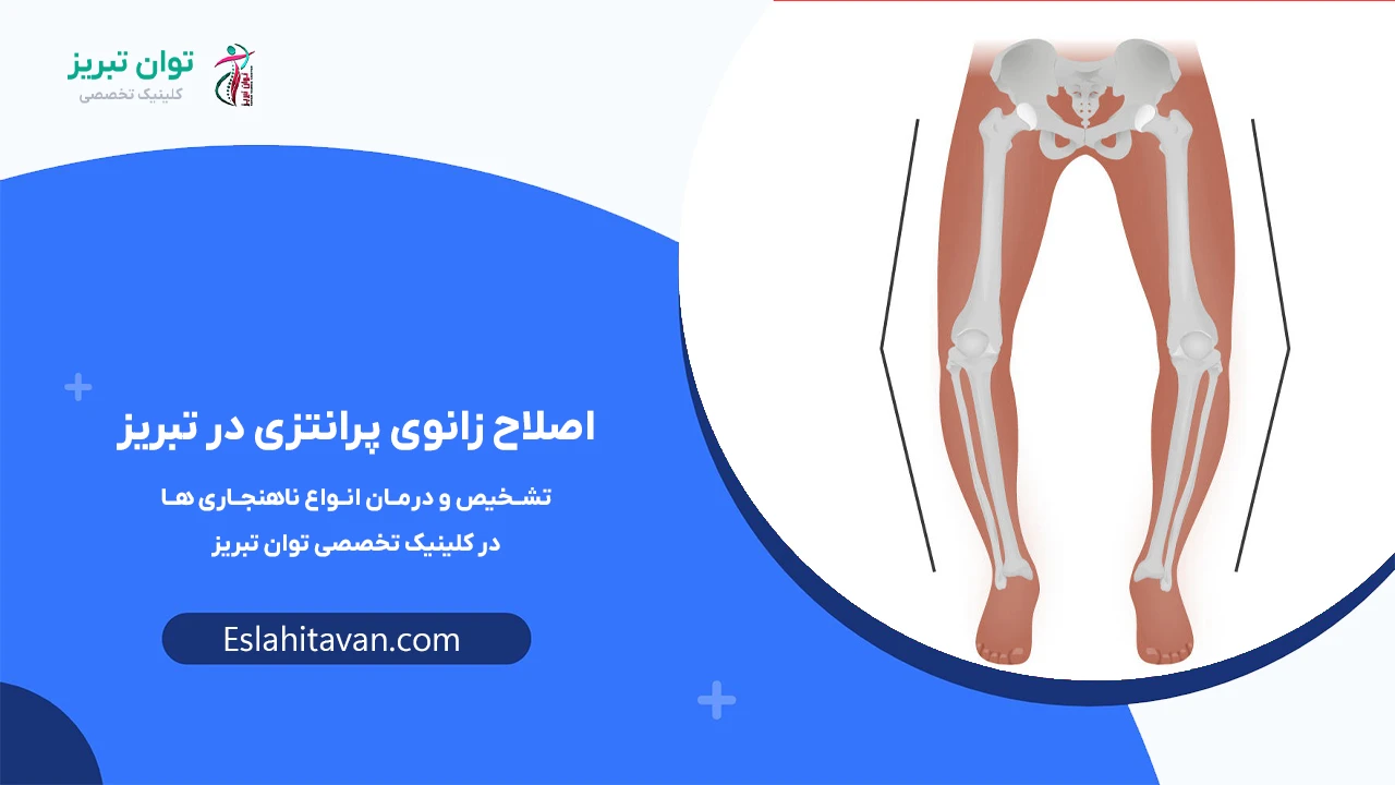 اصلاح-زانوی-پرانتزی-در-تبریز