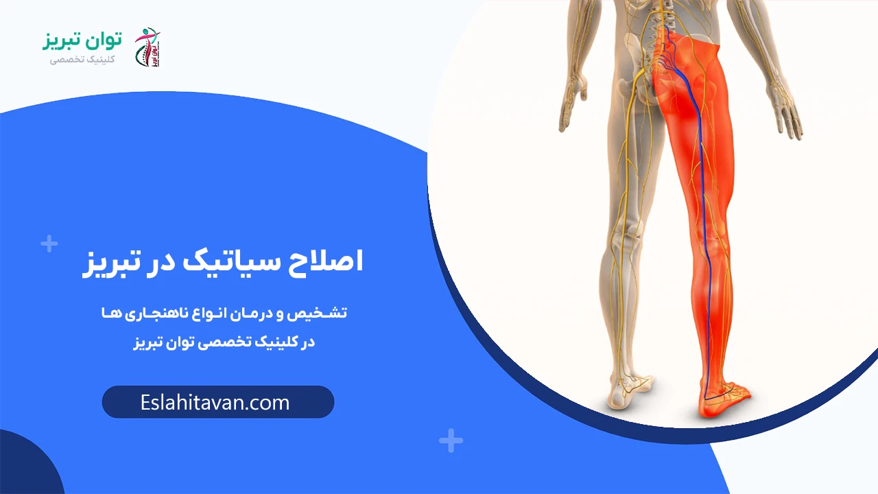 اصلاح-سیاتیک-در-تبریز