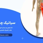 سیاتیک چیست و چه علائمی دارد؟