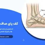 کف پای صاف چیست؟